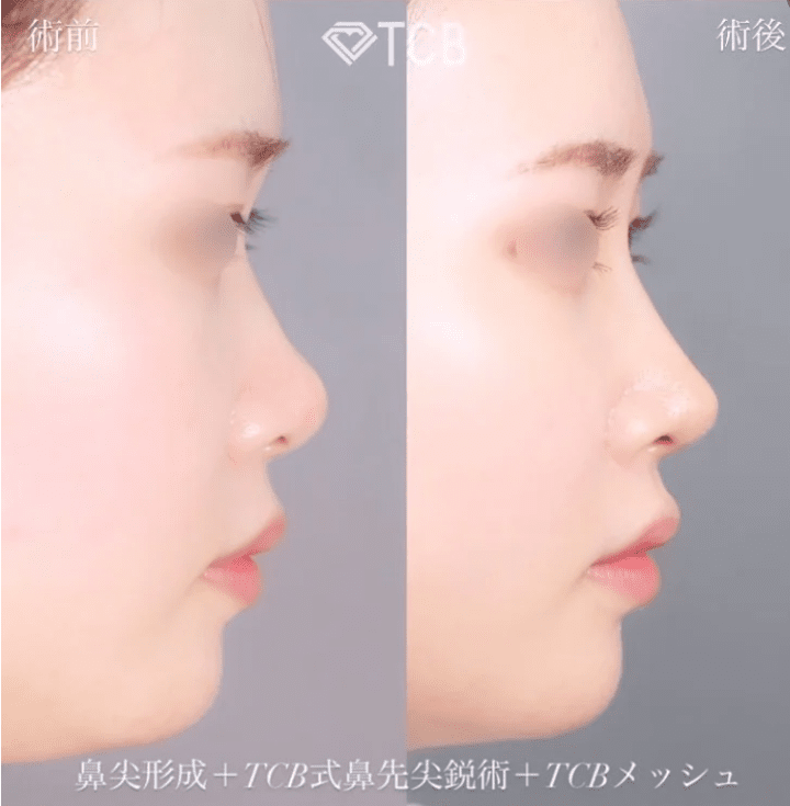TCBは14万件以上の症例があり、理想とする鼻筋が見つけやすい