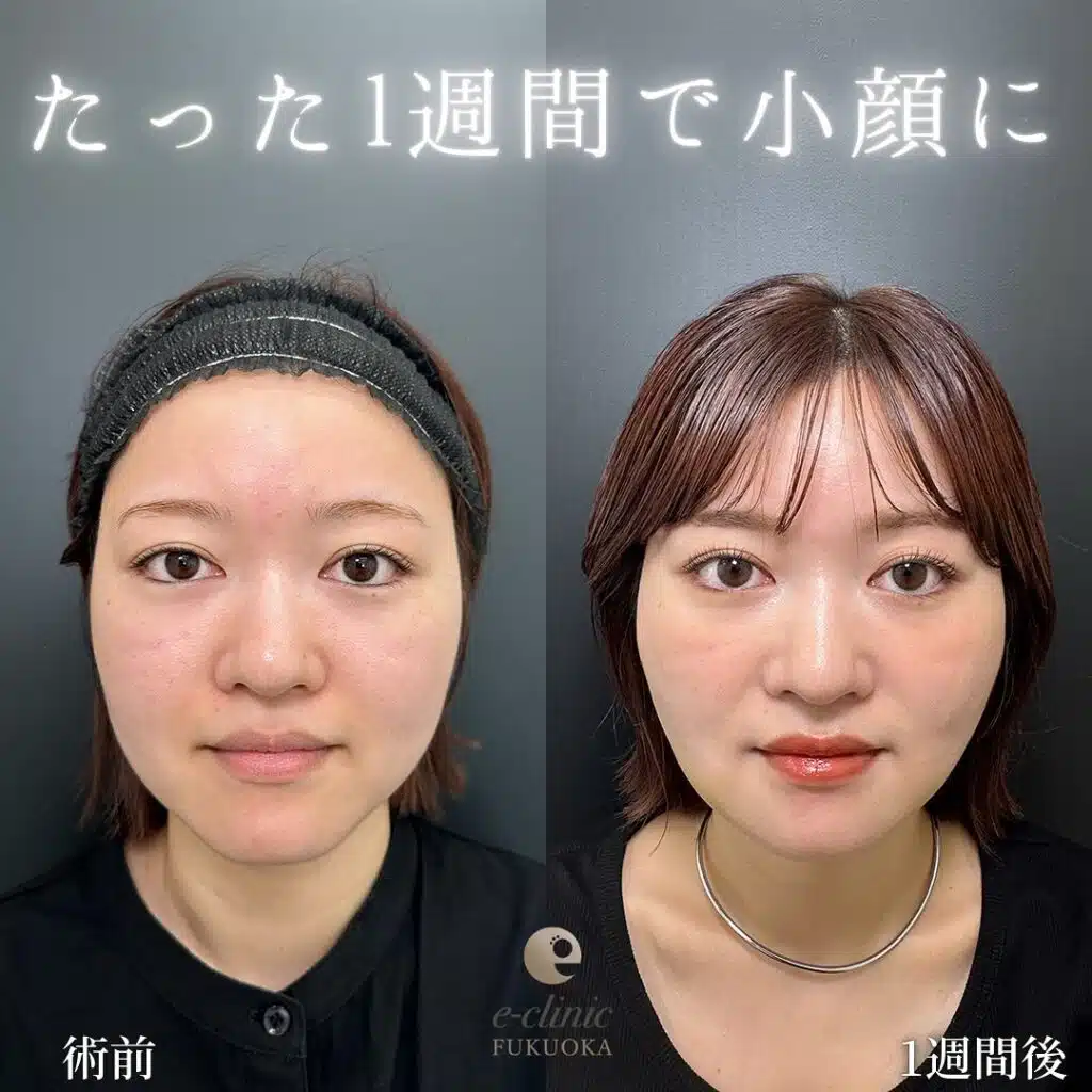 ジョールファット除去の症例写真