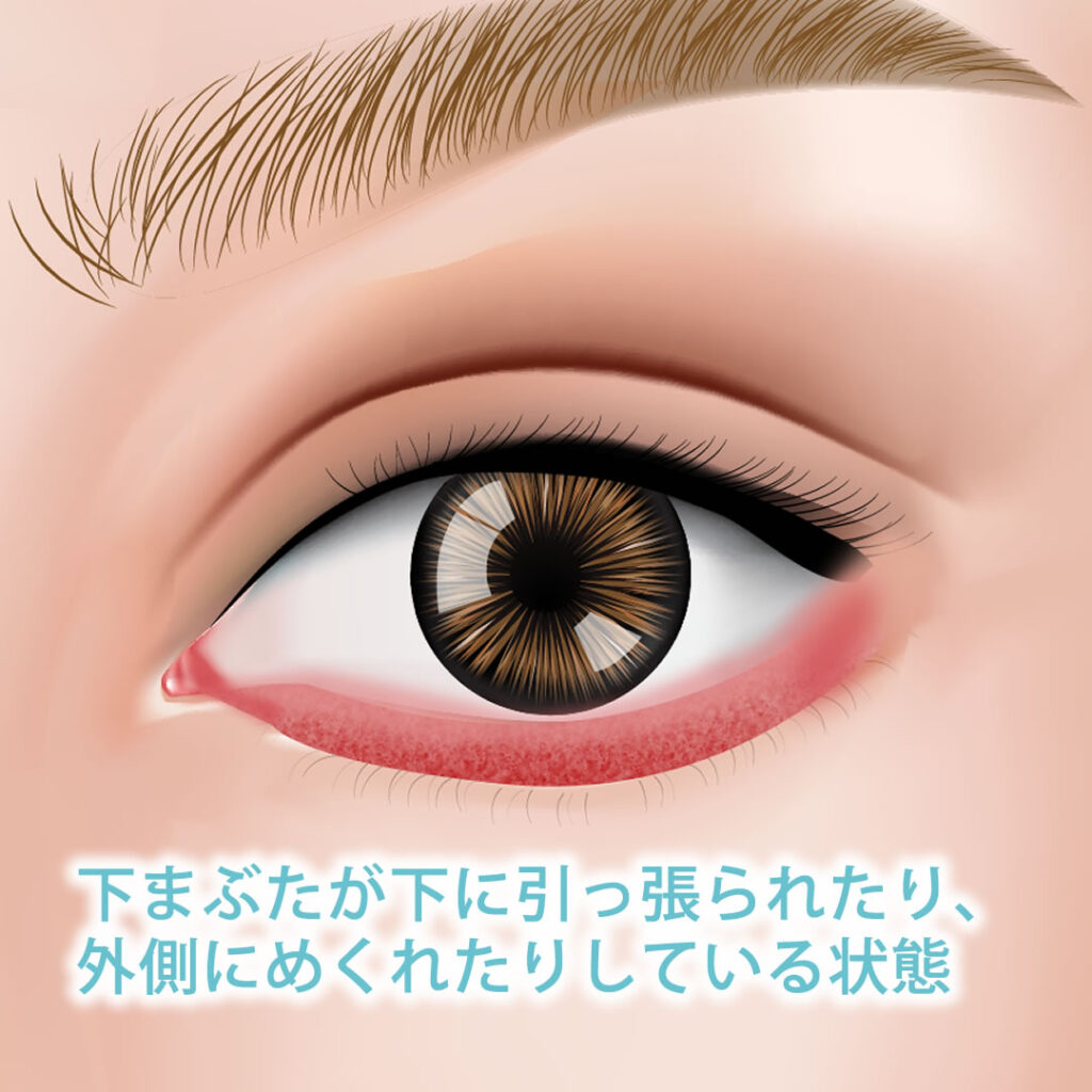眼瞼外反の図解