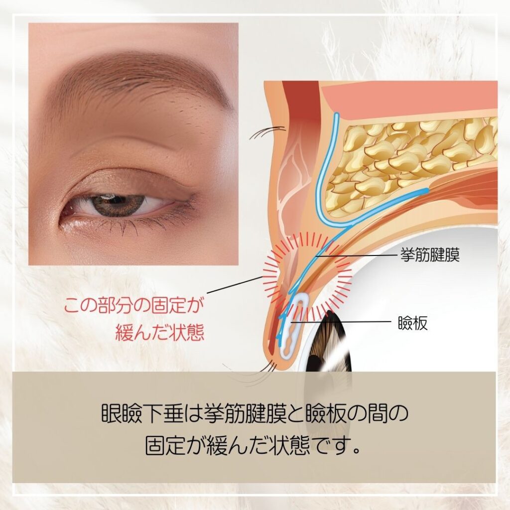 腱膜性眼瞼下垂の図解