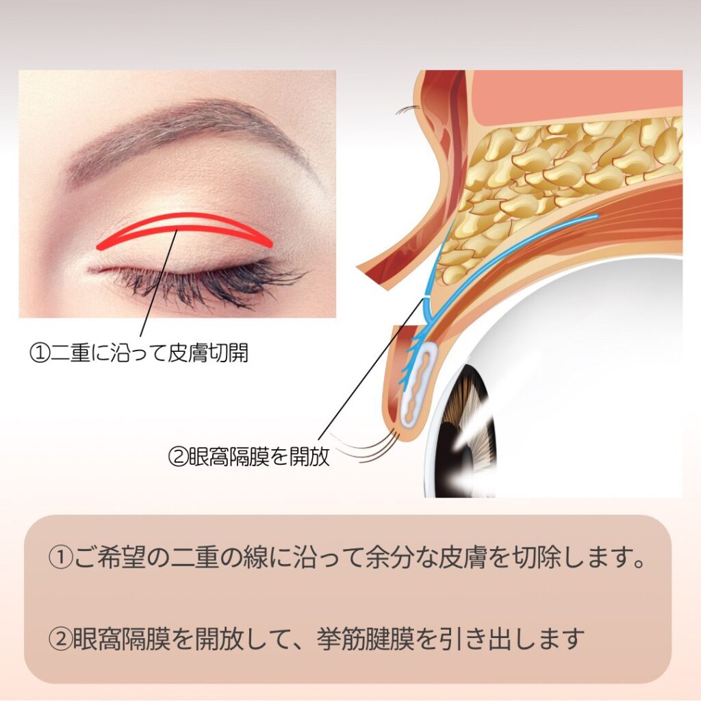 眼瞼挙筋前転法の手術方法の図解