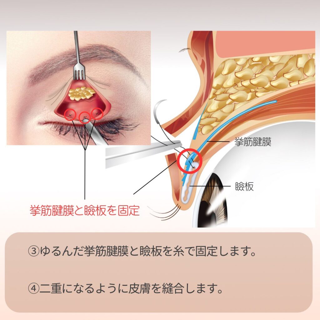 挙筋腱膜と瞼板を糸で固定している図解
