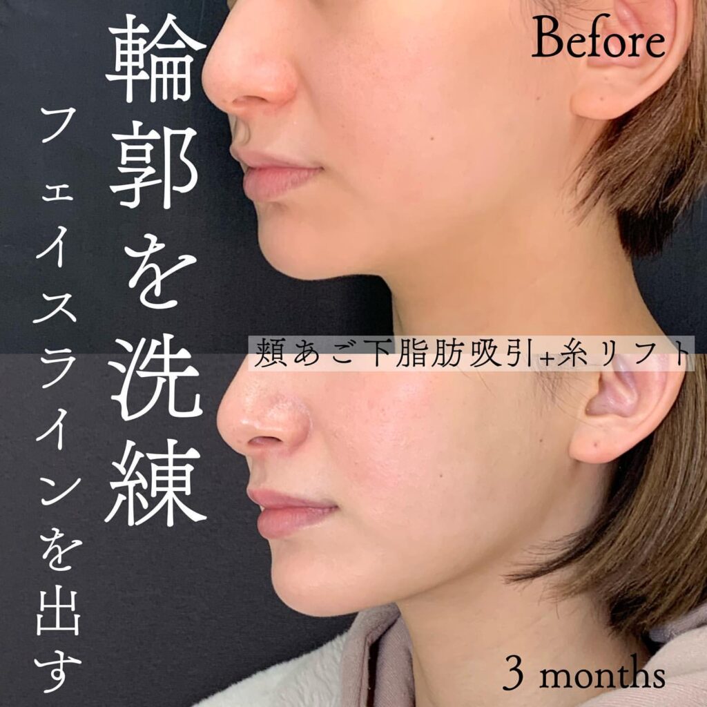 顎下の脂肪吸引と糸リフトの症例写真 (7)