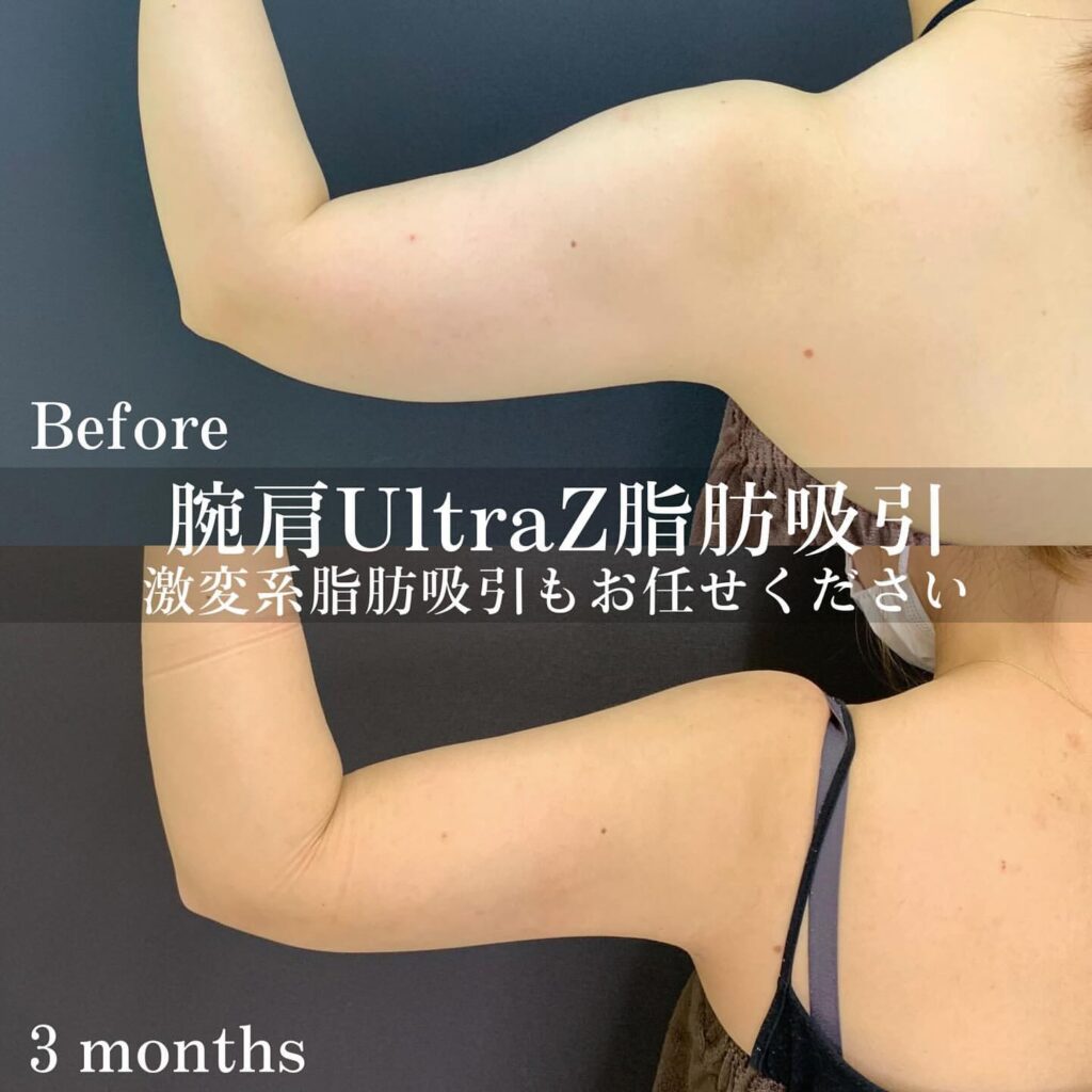 二の腕の脂肪吸引の手術前と3か月後の症例 (3)