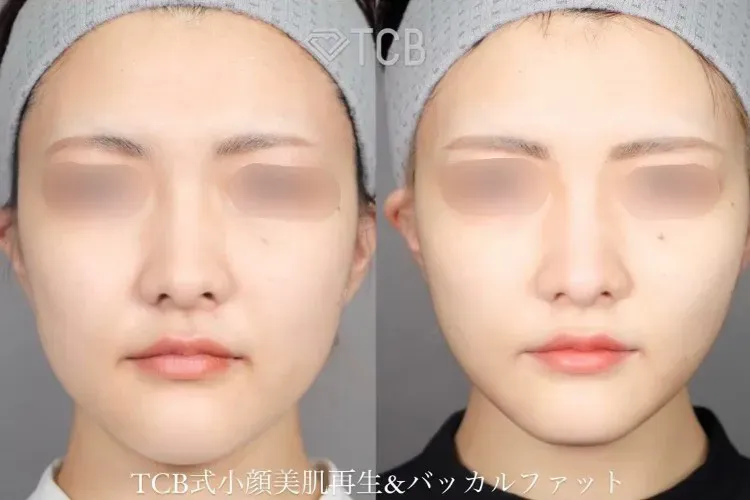 TCBの糸リフトの症例写真