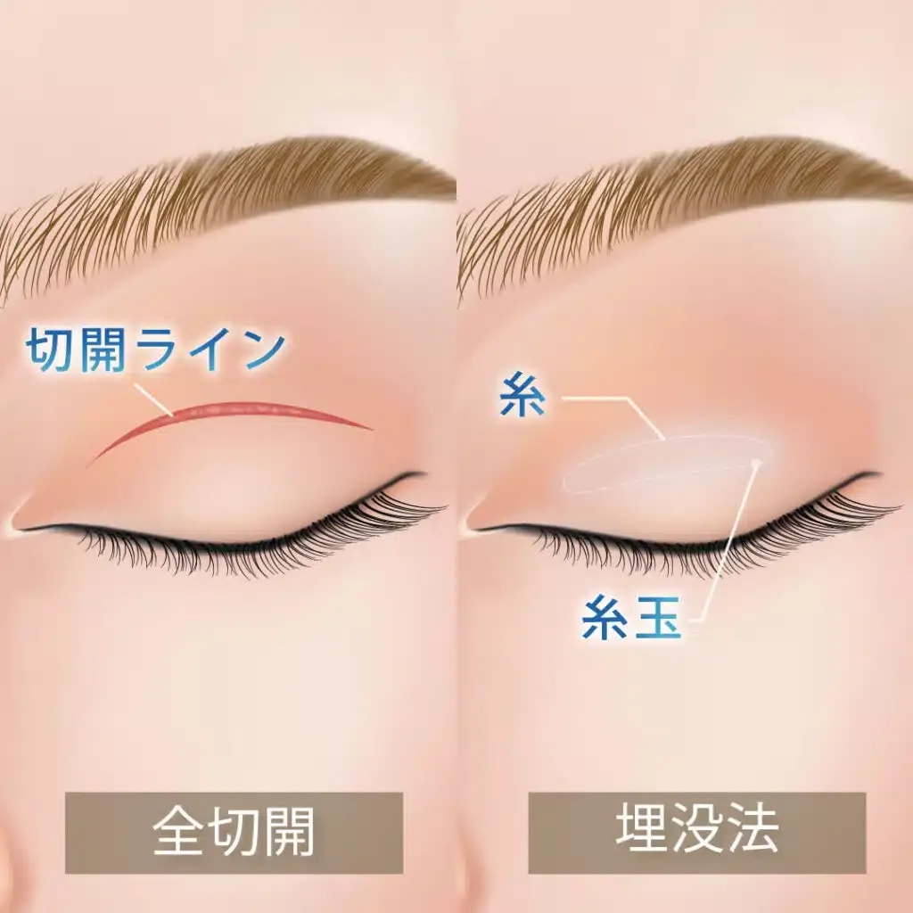 二重整形の埋没法と切開法の違い
