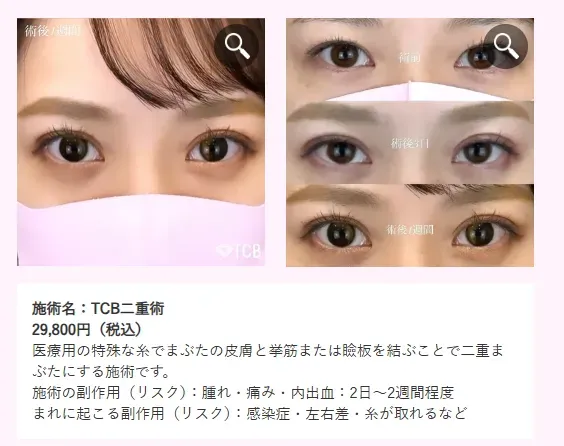 二重整形はTCBがおすすめ