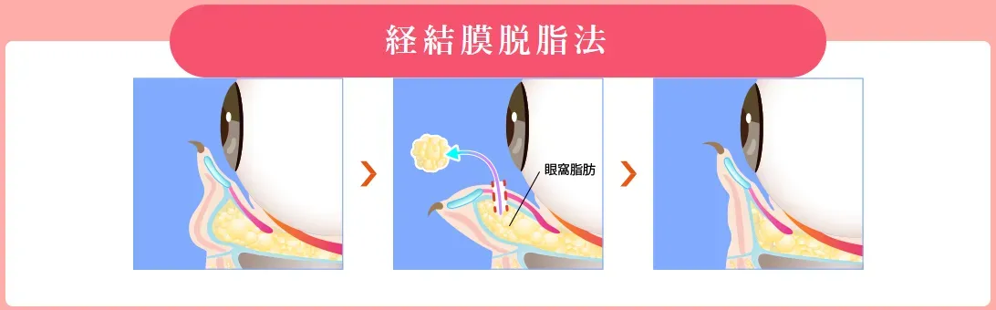 TCBのクマ取りスタンダードで行う経結膜脱脂法