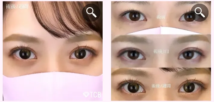TCBの二重整形-施術症例写真