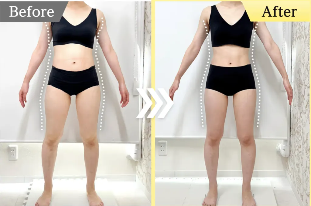 医療ダイエットでおすすめのエミナルクリニックの症例写真