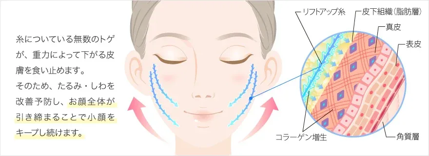 神戸でおすすめのTCBの糸リフト説明