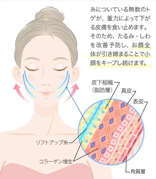 神戸でおすすめのTCBの糸リフトの効果説明説明