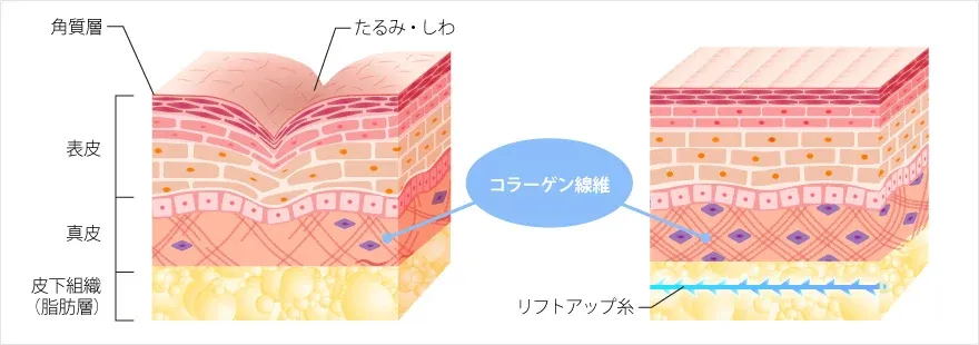 神戸でおすすめのTCBの糸リフトの効果説明画像