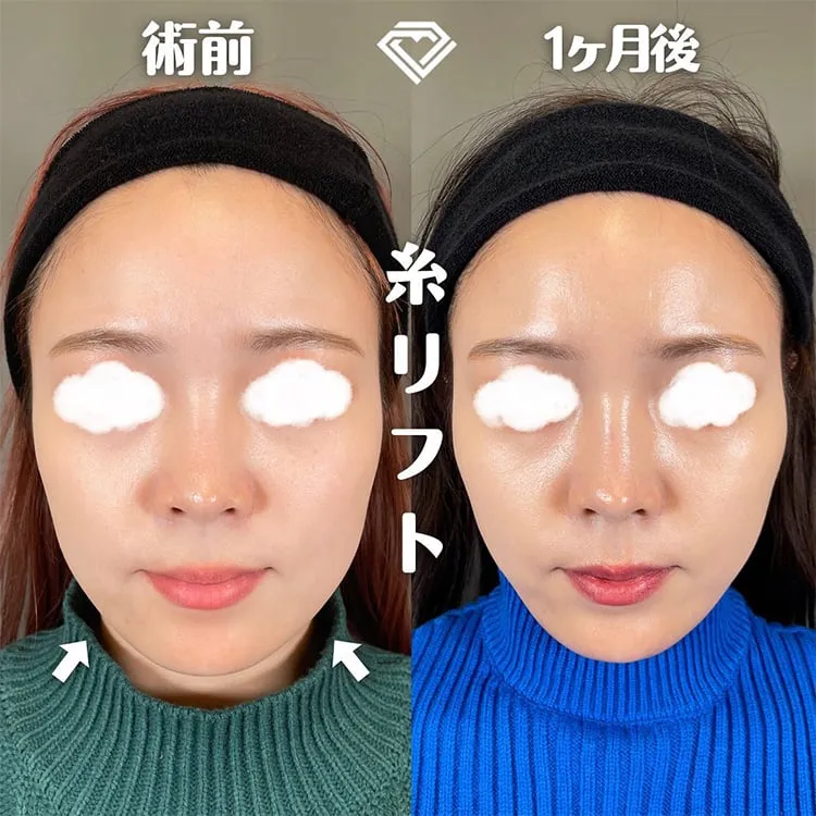 TCBの糸リフトの症例写真