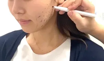 糸リフトのシュミレーション