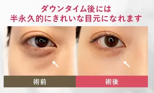 TCBのクマ取り治療のダウンタイム後
