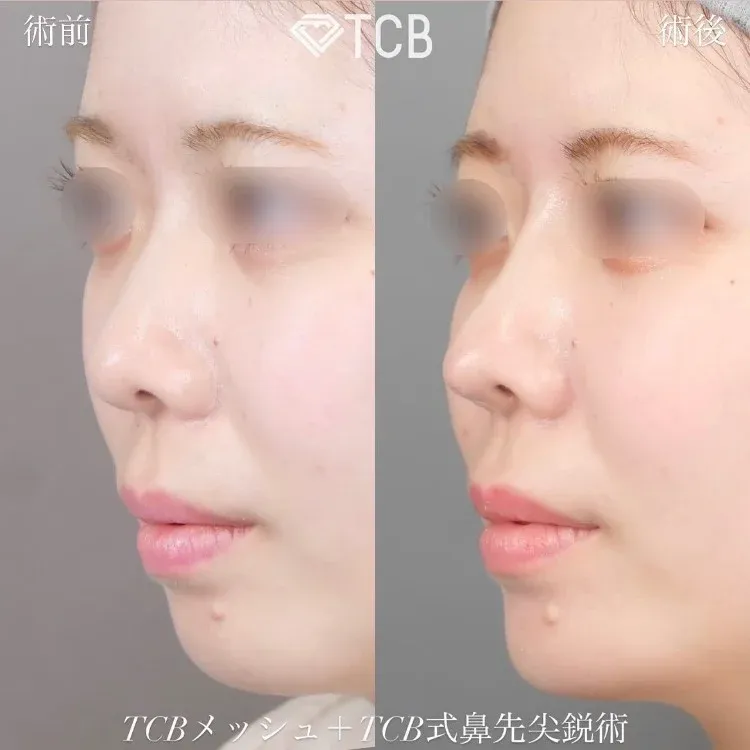TCBメッシュの施術効果