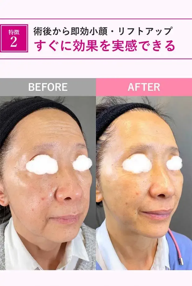 糸リフトの症例写真
