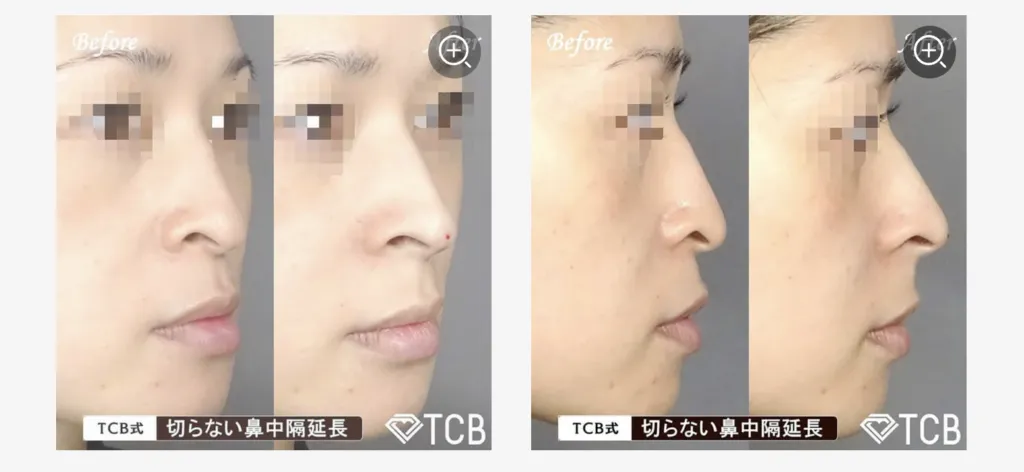 tcb鼻整形のビフォーアフター