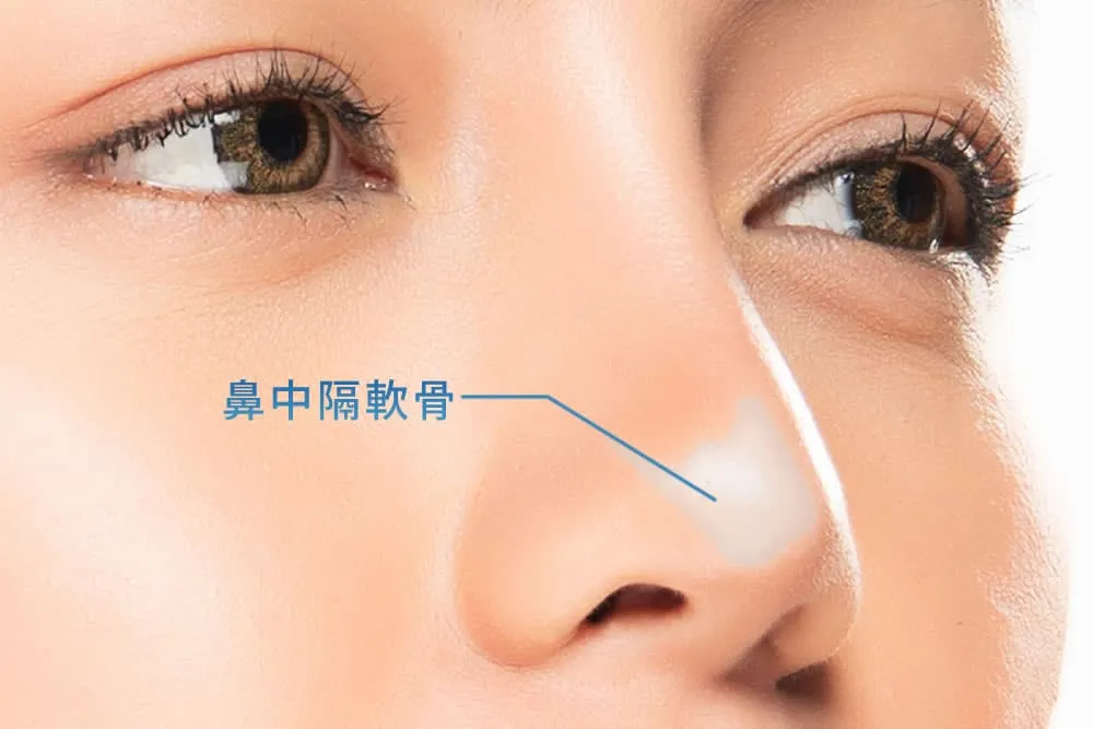 鼻中隔延長では鼻中隔軟骨を強化する
