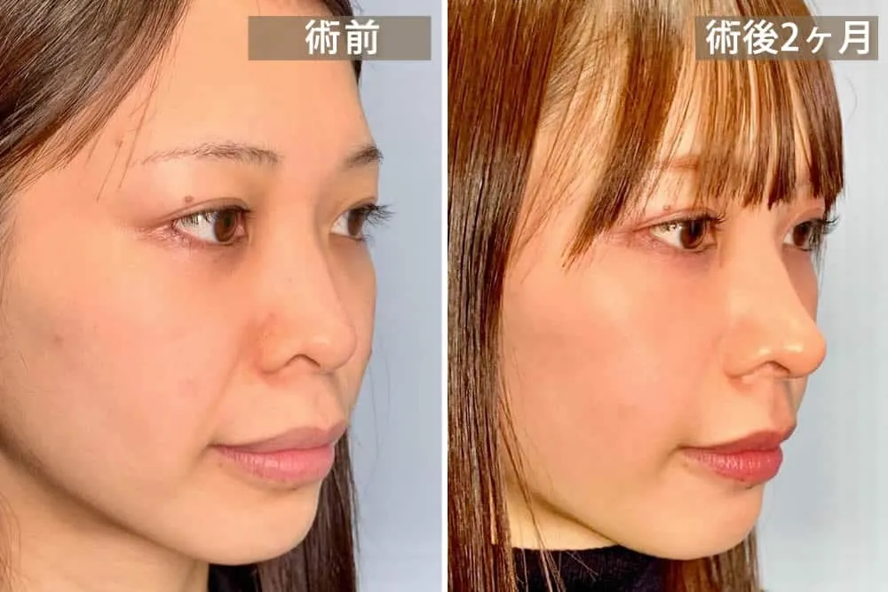 軟骨移植と鼻中隔延長手術を併用した図解