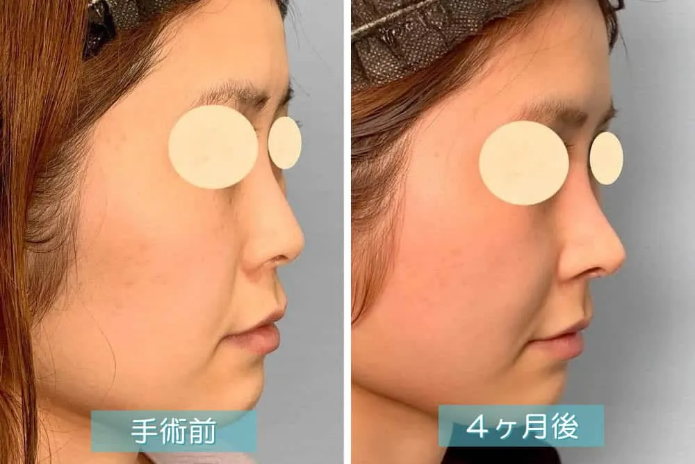 鼻プロテーゼの症例写真