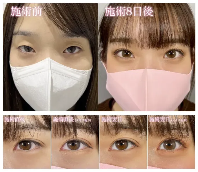 ベリンダクリニックの二重整形の施術後の経過
