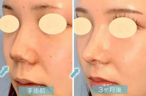 まぶたのクリニックの鼻唇角形成術の症例写真