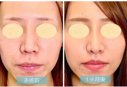 まぶたのクリニックの鼻唇角形成術の症例写真