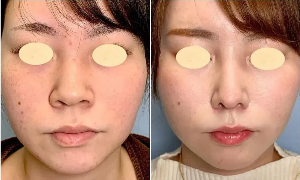 まぶたのクリニックの小鼻縮小の症例写真