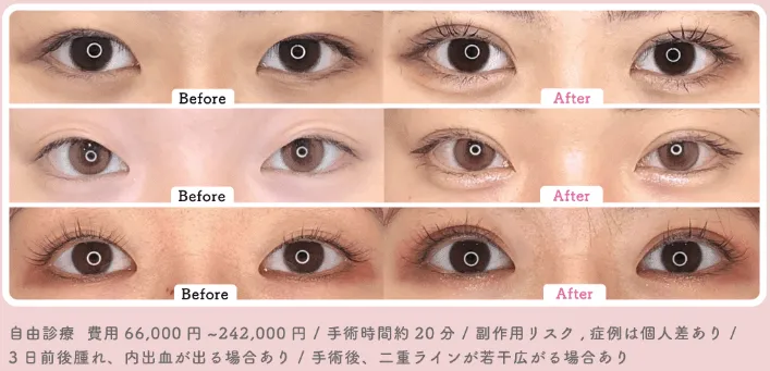 共立美容外科のP-PL挙筋法(埋没法)