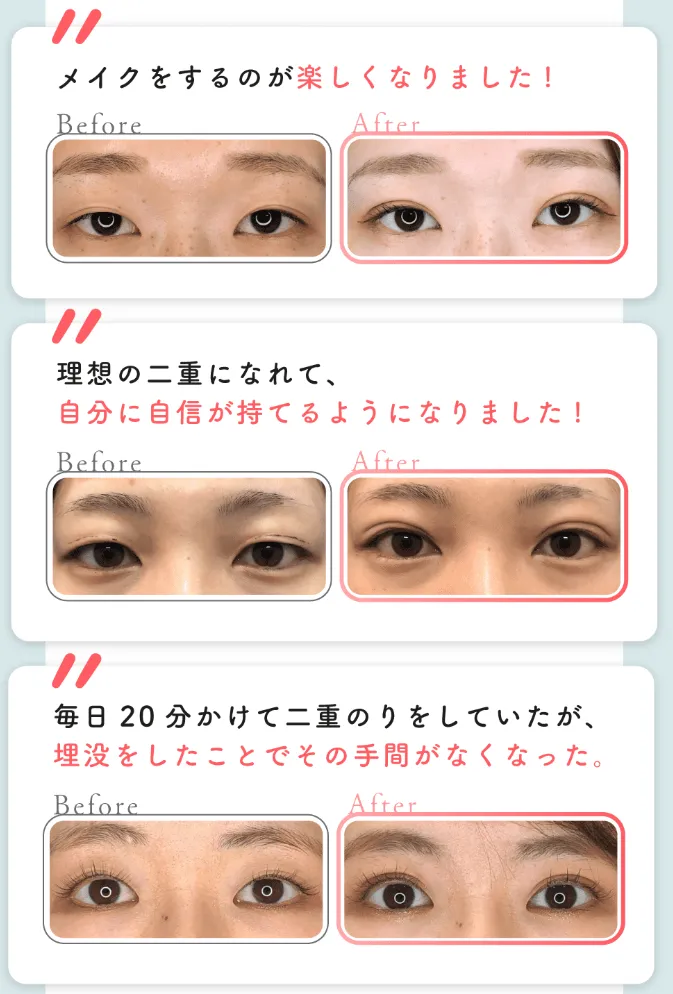 共立美容外科のP-PL挙筋法(埋没法)はメイクをするのが楽しくなるほど綺麗に仕上がる