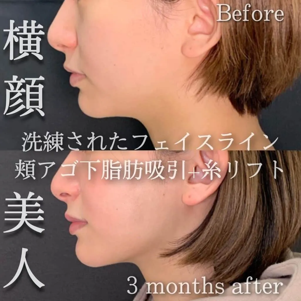 まぶたのクリニックの症例(顔の脂肪吸引)