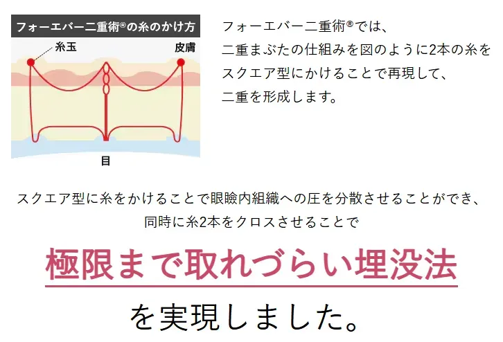 湘南美容外科のフォーエバー二重術は取れづらい施術方法