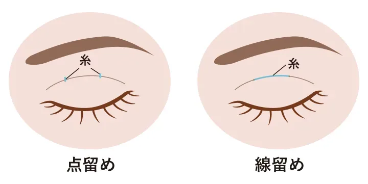 二重整形の点留めと線留めの違い