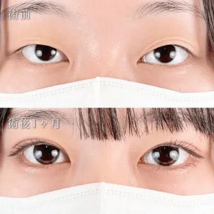 TCB東京中央美容外科 全国109院の二重整形の症例① 10代女性