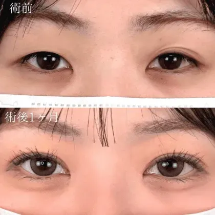 TCB東京中央美容外科 全国109院の二重整形の症例② 20代女性