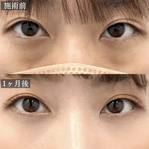 銀座でクマ取りがおすすめのクリニック　TCB　症例写真