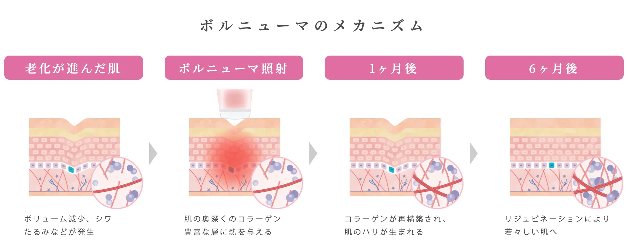 ボルニューマのメカニズム 効果が出やすい理由