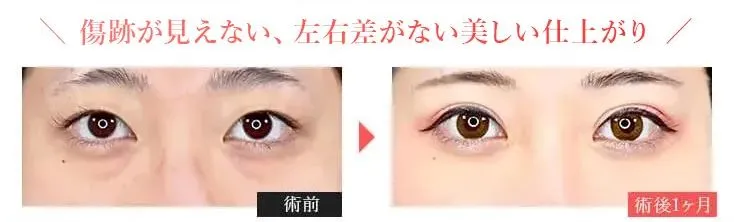 TCBのクマ取りの症例画像