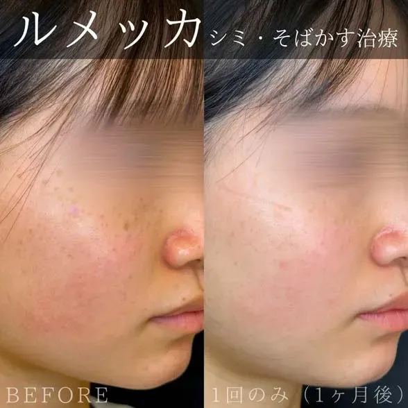 ルラ美容クリニックのルメッカ症例写真