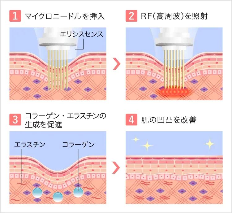 TCBのエリシスセンスの施術内容