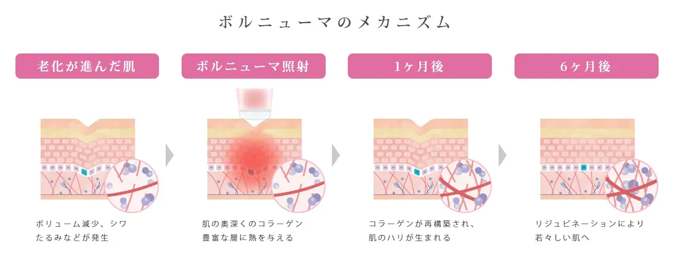 ボルニューマの効果が高いルラ美容クリニック ボルニューマのメカニズム