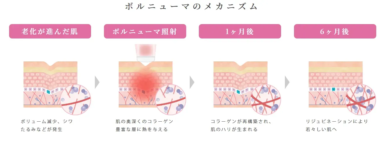 ボルニューマのメカニズム