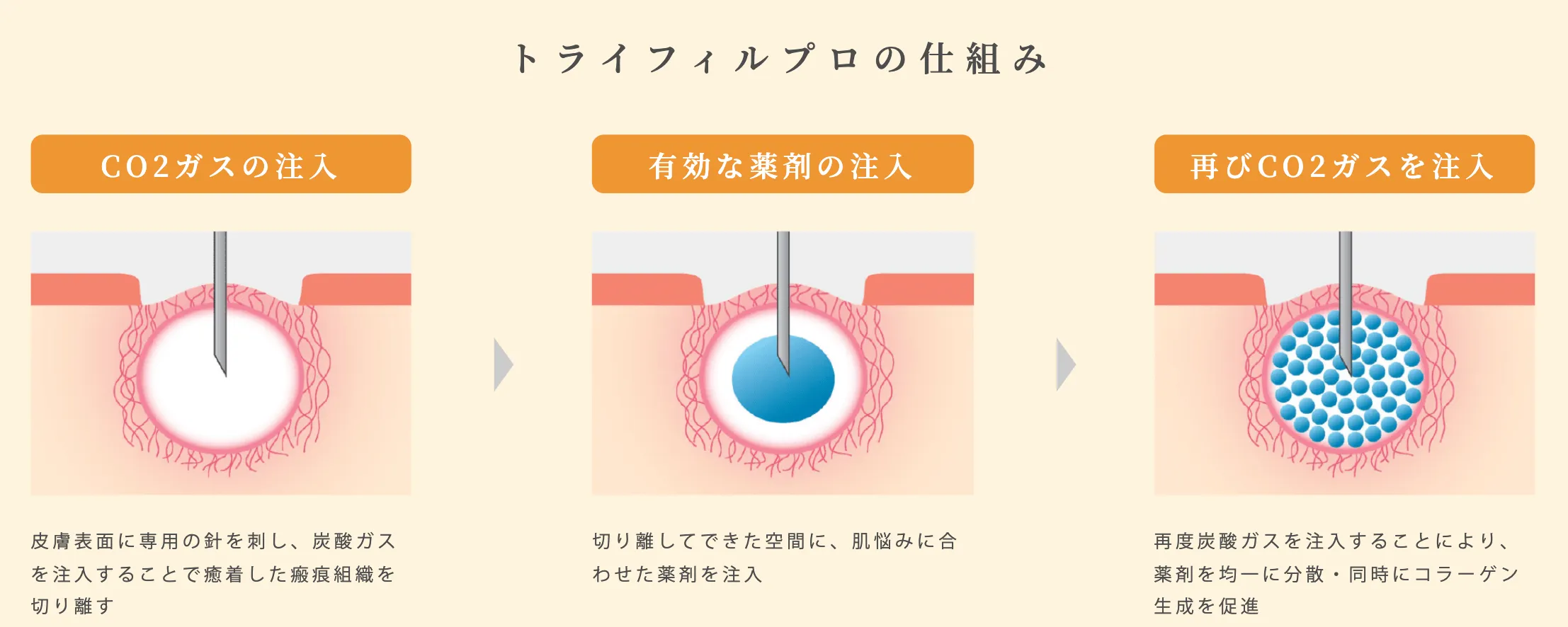 トライフィルプロの仕組み