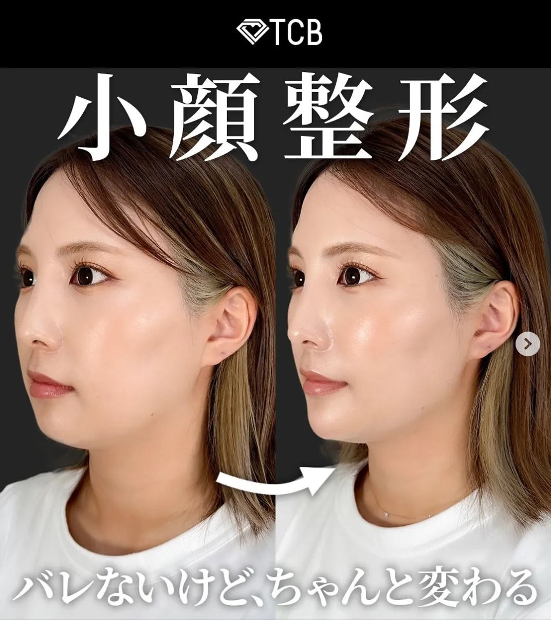 TCB千葉東口院症例写真