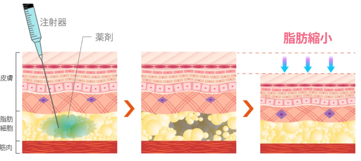 TBCの脂肪溶解注射メカニズム