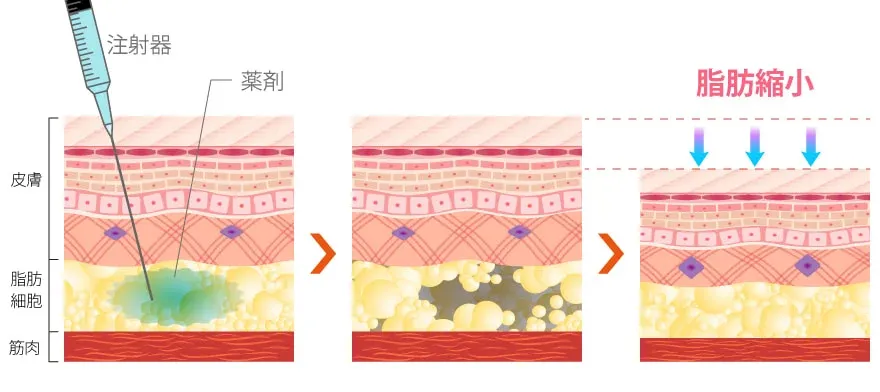 脂肪溶解注射の仕組み