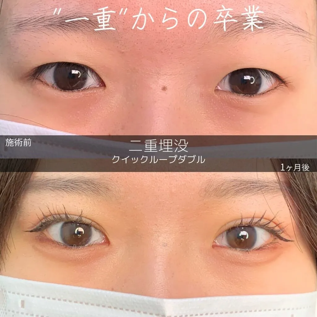 二重埋没の症例