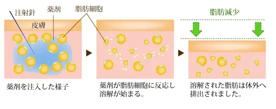 脂肪溶解注射 仕組み